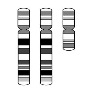 The goal of this diagram is to illustrate the chromosome conformation that is Tetrasomy 18p. The diagram includes two images of a normal copy of chromosome 18 as well as a third extra chromosome composed of two chromosome 18 short or p arms joined together at their centromeres in an invered arrangement. Next to this diagram is a text box that says: Tetrasomy 18p. This condition is caused by an extra chromosome composed of 2 chromosome 18 p arms (i.e. an isochromosome). This results in a total of 4 copies of each of the genes on 18p. the p arm of chromosome 18 has 66 genes. Little is known about how the presence of four copies of these genes directly relates to the clinical features associated with Tetrasomy 18p. Therefore, we base our recommendations on descriptive studies of individuals with this condition.